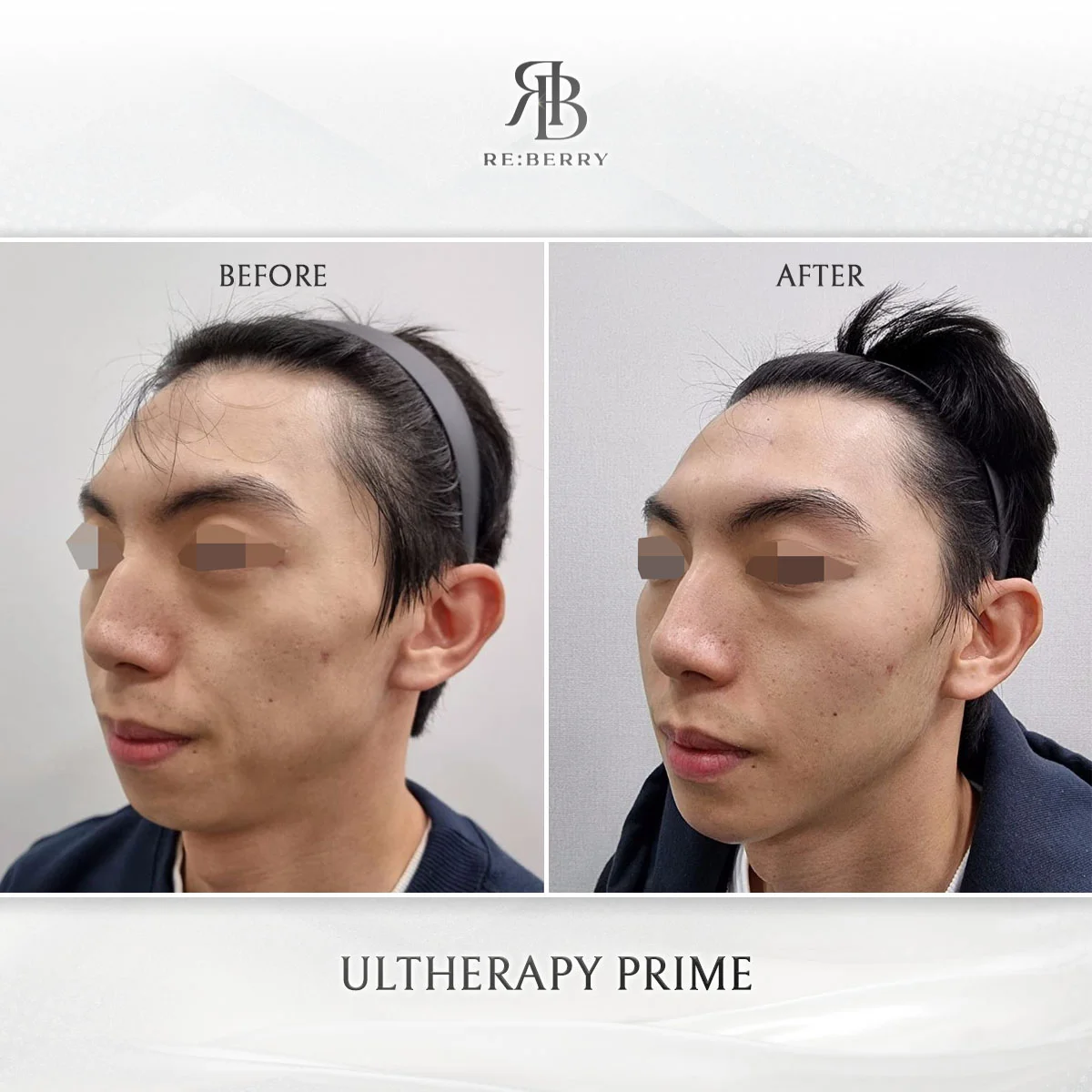 Ultherapy Prime HIFU before and after — male patient jawline lifting result at RE:BERRY Clinic Gangnam